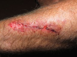 Wound2